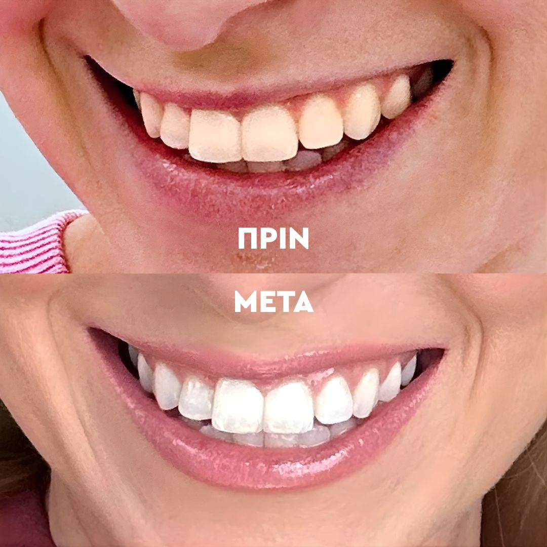 Σκόνη Λεύκανσης Δοντιών