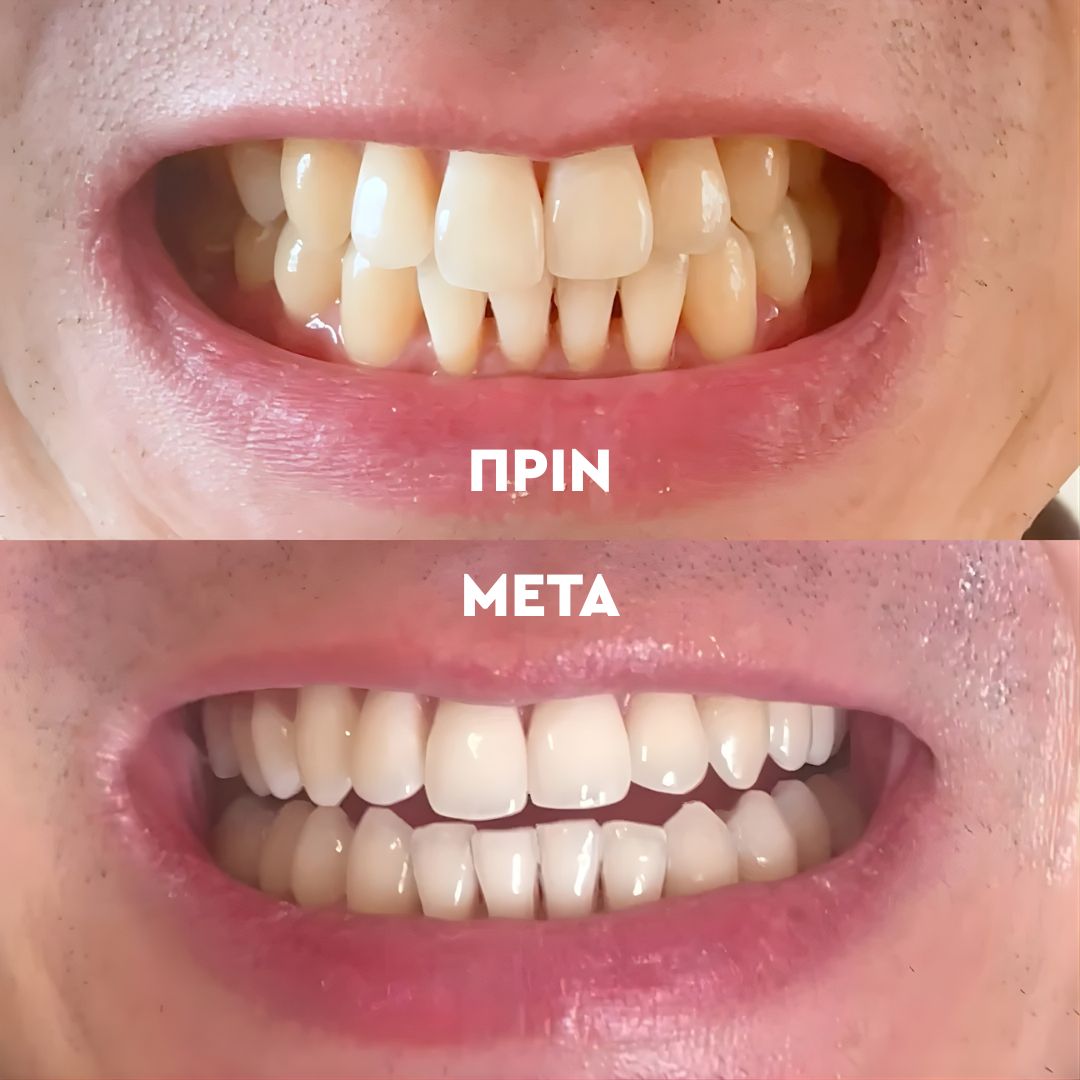 Σκόνη Λεύκανσης Δοντιών